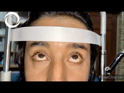 Diplopia patient(Urdu/Hindi)