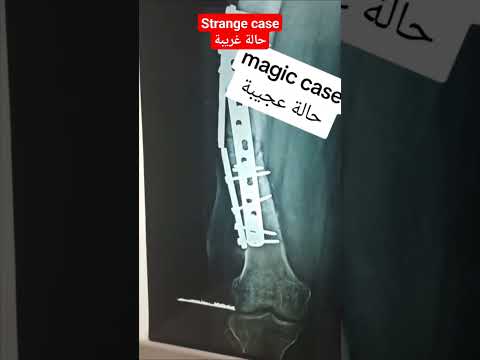 حالة غريبه    جراحة عظام  کسور أفضل طبيب عظام وعمود فقري عظام