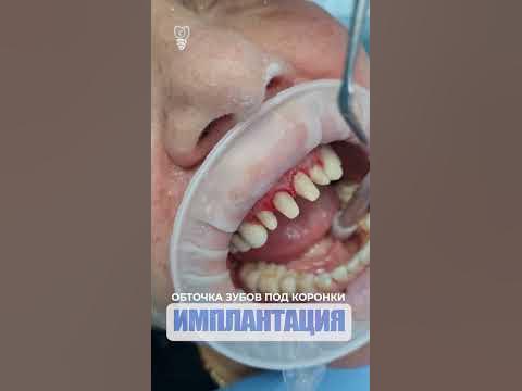 От клиновидных дефектов до временных коронок. From wedge-shaped defects ...