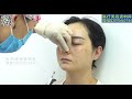 微整注射手术示教：打造面部立体感与高级感