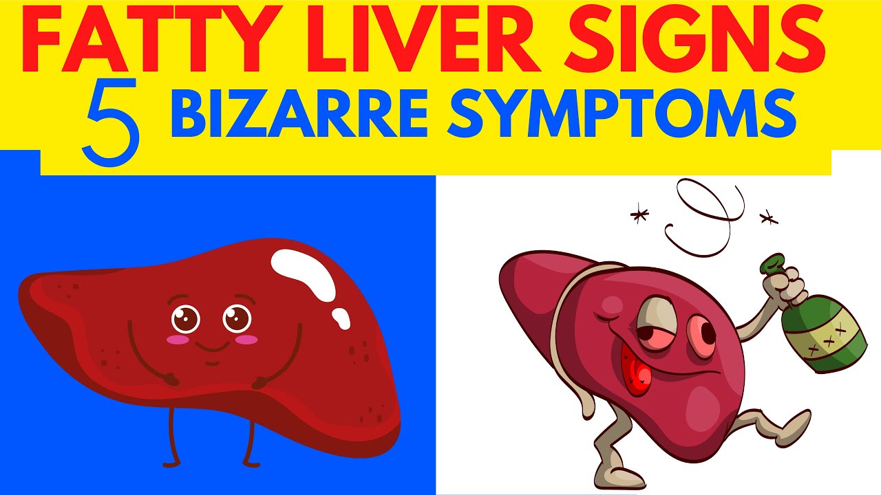 Fatty Liver Signs Bizarre Fatty Liver Signs And Symptoms Fatty Liver Fatty liver signs bizarre fatty liver signs and symptoms fatty liver