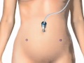 Minimally invasive hysterectomy