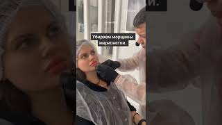 Коррекция морщин марионеток. #морщинымарионетки