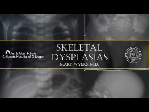 Video: Memperluaskan Fenotip Dari Skeletal Displasias Skeletal Yang Berkaitan Dengan BMPER Kepada Disko Ischiospinal