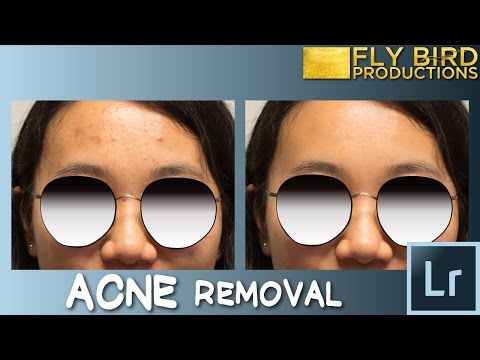 How To Easily Remove Acne/Blemishes/Skin Bumps In Adobe Lightroom CC