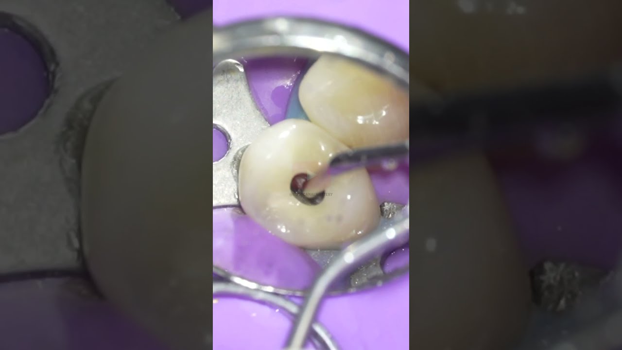 Root Canal Procedure Rootcanal