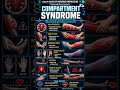 Compartment Syndrome | NCLEX Quick Revision - Nootropic Nurse