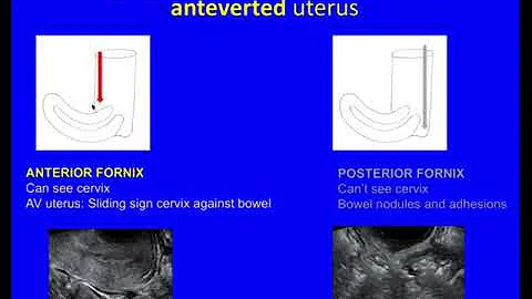 Webinar Replay: How to diagnose Endometriosis on U...