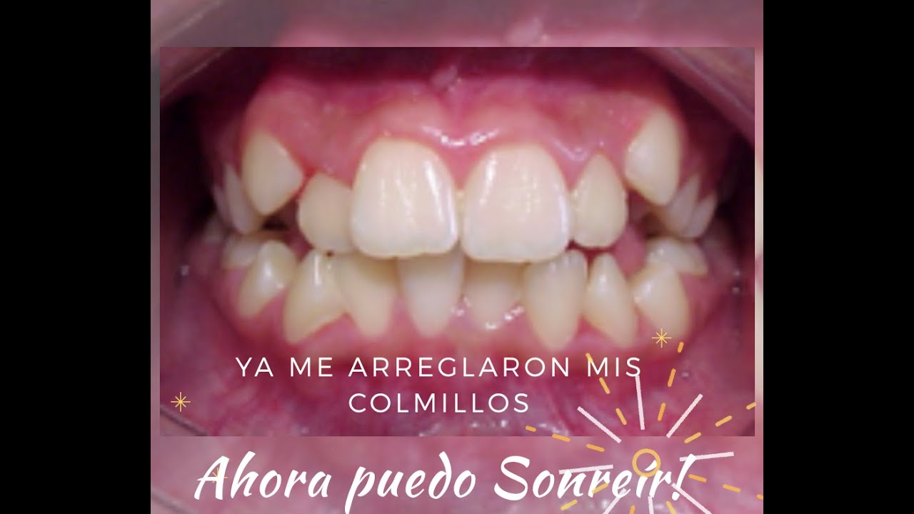 Dientes chuecos (colmillos montados)Corrección de apiñamiento dental