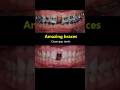 Amazing braces. Close gap teeth #orthodontist #braces #dentist
