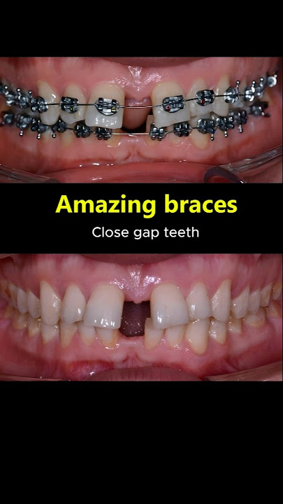 Amazing braces. Close gap teeth #orthodontist #braces #dentist