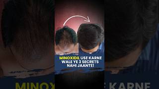 Minoxidil Use Karne Wale Ye 3 Secrets Nahi Jaante