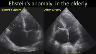 Ebstein's Anomaly