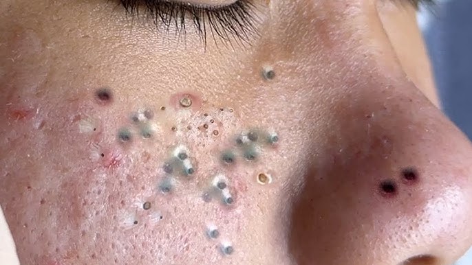 Blackheads & Acne Treatment 18.05.2024 (Part 7) #blackhead #whitehead #acne  #blackheadremoval - YouTube