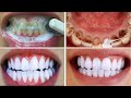 Teeth Whitening At Home In 3 Minutes || How To Whiten Your Yellow Teeth Naturally || 100% Effective