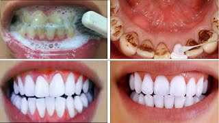 Teeth Whitening At Home In 3 Minutes || How To Whiten Your Yellow Teeth Naturally || 100% Effective