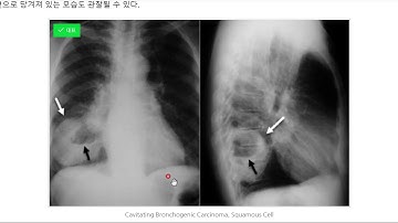 폐암(lung cancer): 편평세포암종(Squamous cell carcinoma)의 영상소견