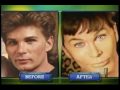 Steve Erhardt's Plastic Surgeries