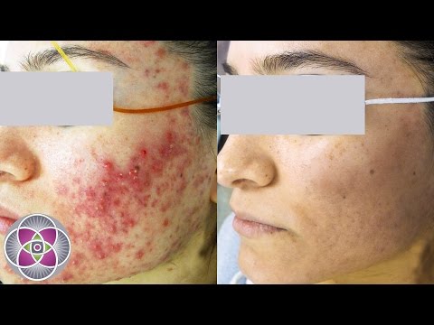 Laser Treatment To Get Rid Of Acne & Acne Scars