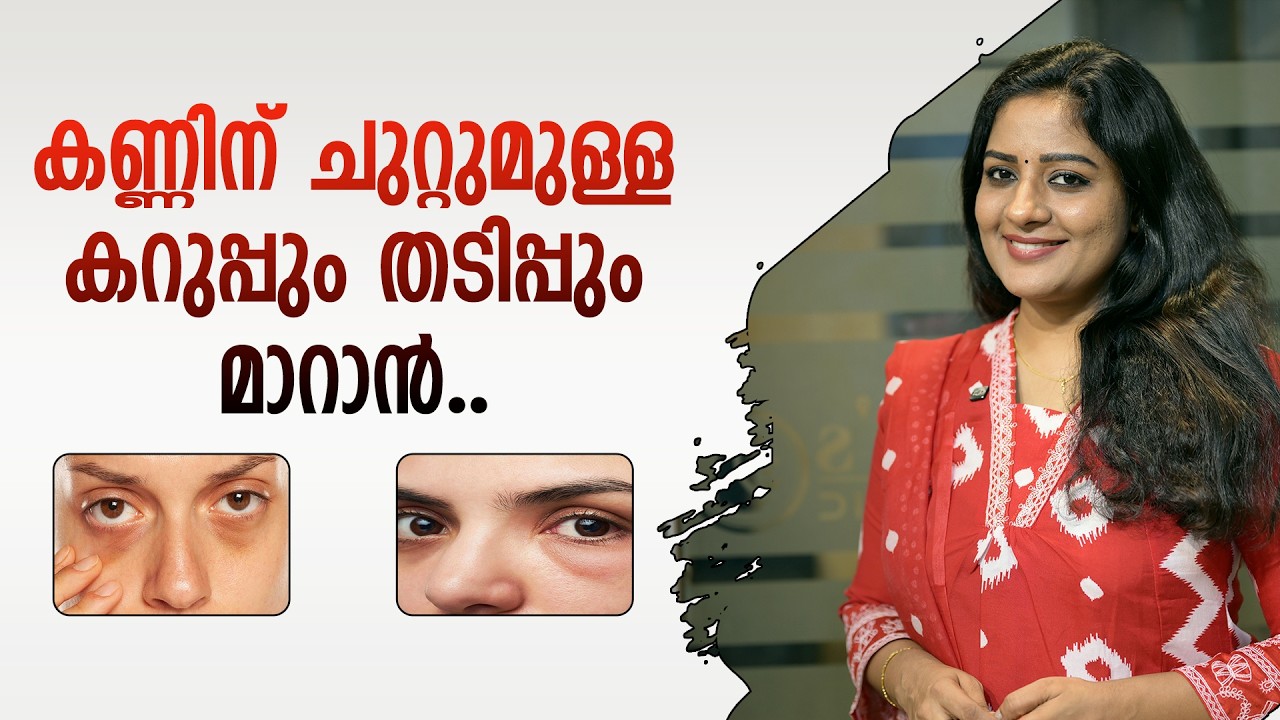 കണ്ണിന് ചുറ്റുമുള്ള കറുപ്പും തടിപ്പും മാറാൻ Say Goodbye To Dark Circles & Under-Eye Bags | Remedies