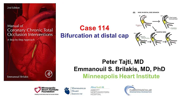 Case 114: Manual of CTO Interventions: Bifurcation at distal cap