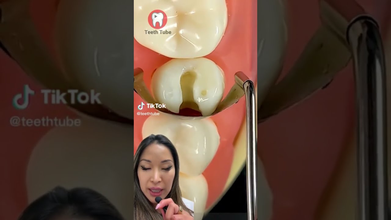 Cavity Filling Procedure Shorts