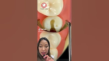 Cavity filling procedure #shorts