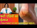 सूखी और फटी एड़ियों का ईलाज || Treatment of Dry and Cracked Heels (In HINDI)