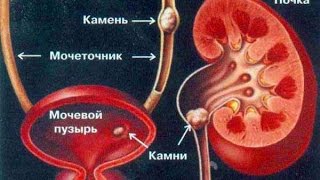▼Мочекаменная Болезнь. Лечение▼|▼Mochekamennaja Bolezn'. Lechenie▼ ▼Мочекаменная Болезнь. Лечение▼|▼Mochekamennaja Bolezn'. Lechenie▼
