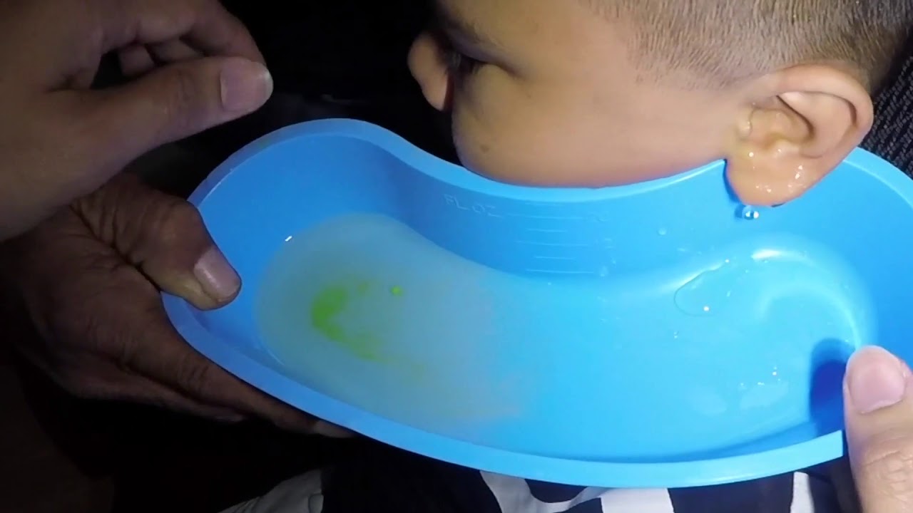 Little Boy's Green Earwax Removed by Ear Irrigation YouTube