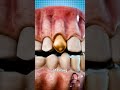 Why Dentists Still Use Gold Teeth 🤔#shortvideo #shorts