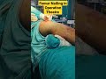 Femur nailing in operation theature femur bone surgery        femur surgeon