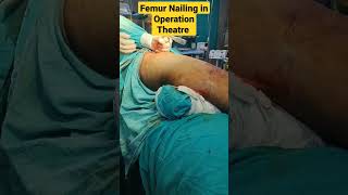 Femur Nailing In Operation Theature Femur Bone Surgery जघ क हडड क आपरशन 