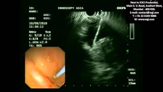 EUS GUIDED DRAINAGE OF PANCREATIC PSEUDOCYST