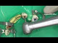 Maxillary canine - Access cavity preparation - Endodontic
