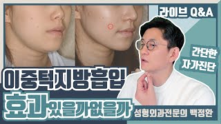 이중턱, 턱밑 지방흡입 효과가 있는지 없는지 자가진단법