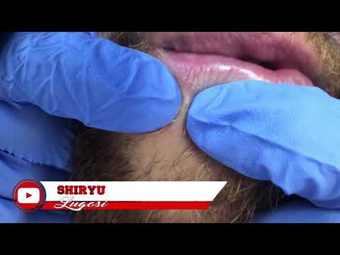 #Lips #Blackhead + #Slowmotion Bonus at 60FPs