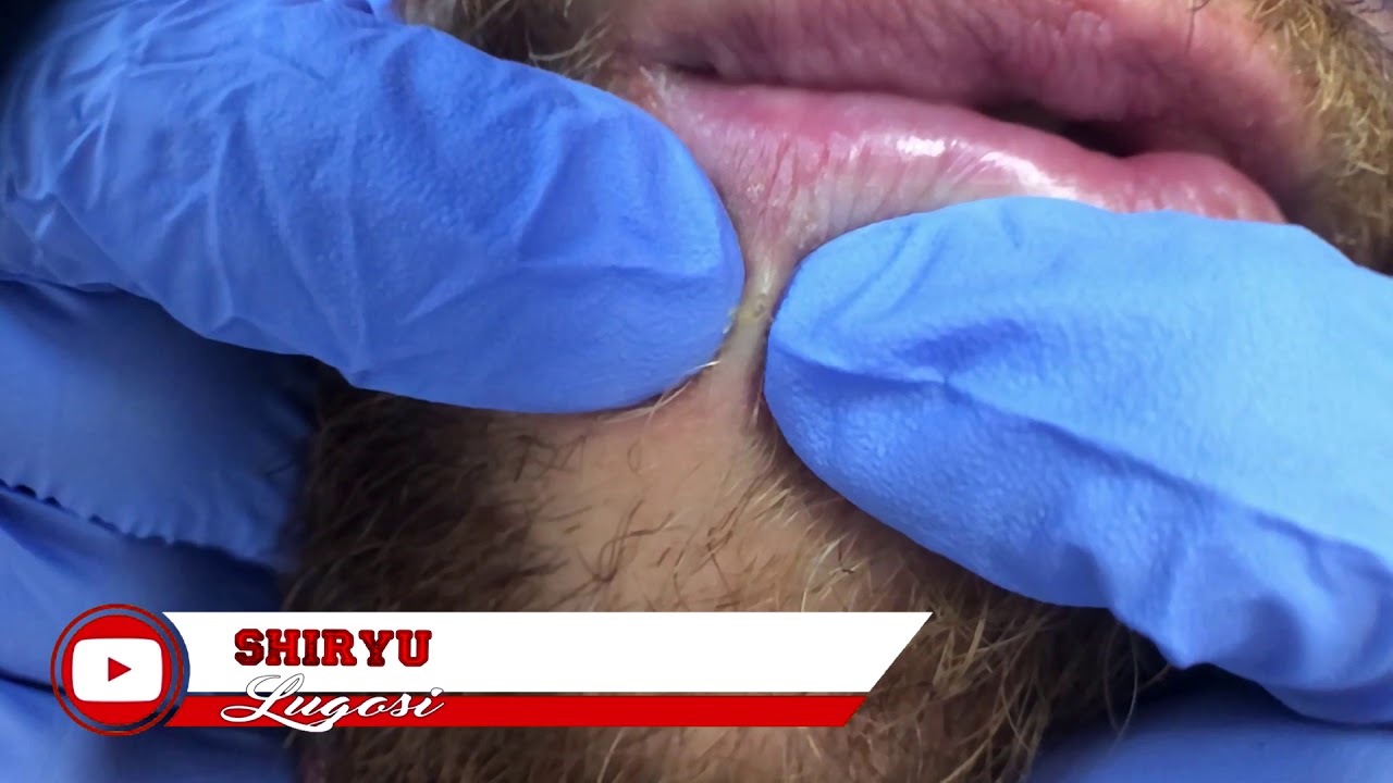 Lip’s Blackhead Plus Slow Motion 4K UHD