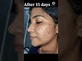 Best Pimple Treatment Best Pimple Treatment