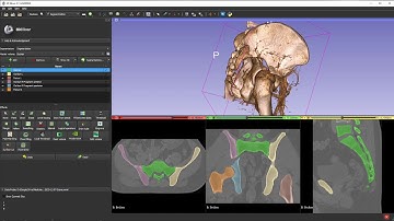 Planning Pelvic Surgery with 3D Slicer and Blender