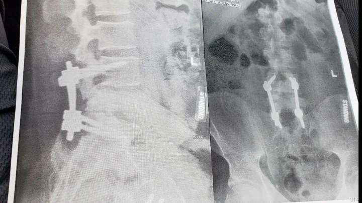 Skydiving Student Accident AFF Level 3