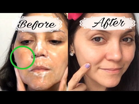 Get rid of dark spots, acne scars and hyper pigmentation