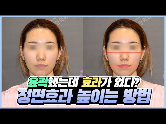 안면윤곽 수술했는데 효과가 없다고? 정면효과 높이는 방법 알려드림😎
