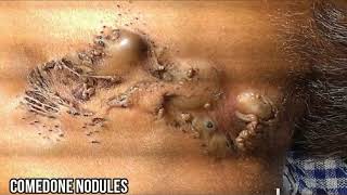 Nevus Comedonicus | Dermatology Discussion