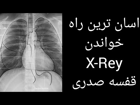 تصویری: نحوه خواندن اشعه ایکس قفسه سینه (همراه با تصاویر)