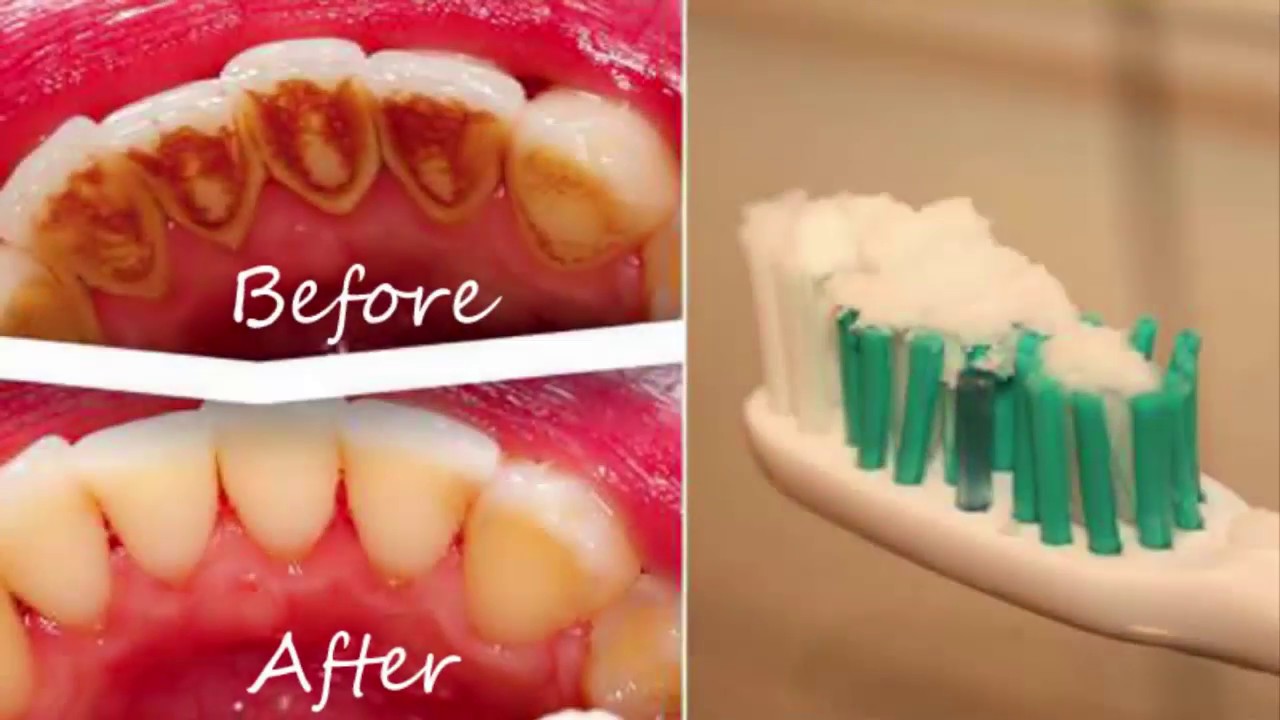 How to Remove Plaque From Teeth At Home Remove Plaque Without Going