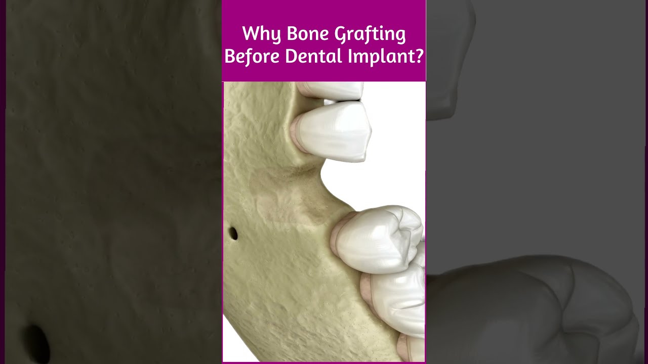 Why Bone Grafting Before Dental Implant 
