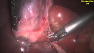 7 Minute laparoscopic cholecystectomy at KAUH