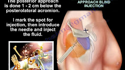 Injections Around The Shoulder - Everything You Need To Know - Dr. Nabil Ebraheim