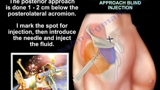 Injections Around The Shoulder  Everything You Need To Know  Dr. Nabil Ebraheim